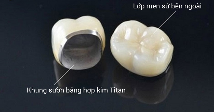 Răng sứ titan
