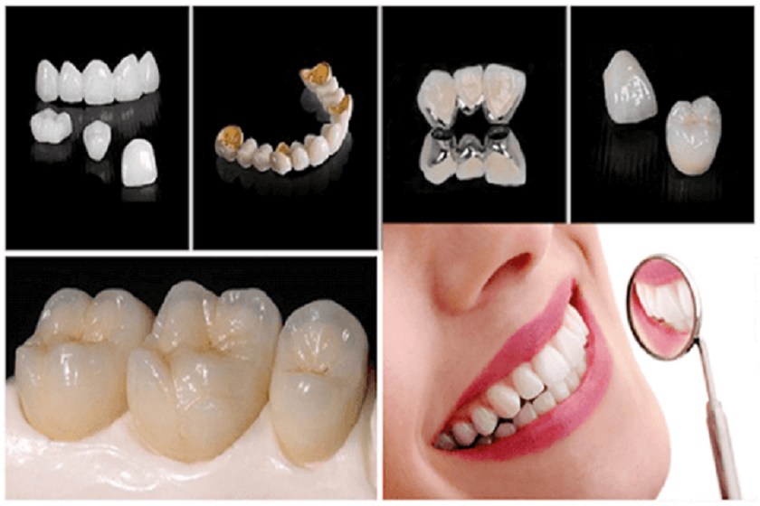 Bọc răng sứ titan có tốt không - Những ưu điểm vượt trội