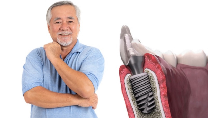 Trụ Implant của Pháp giúp khôi phục toàn diện các chức năng răng