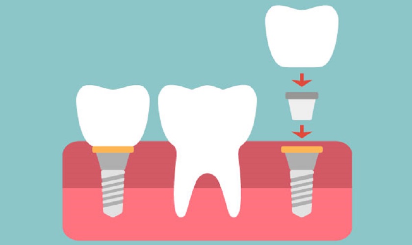 Các giai đoạn trồng răng Implant quan trọng bạn cần biết