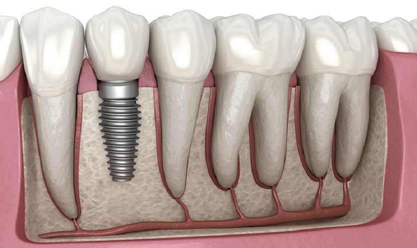 Cách trồng răng Implant có thể bạn chưa biết