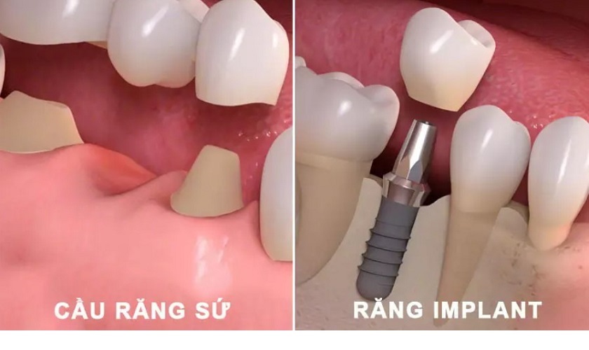 Nên làm cầu răng sứ hay cấy ghép Implant khi bị mất răng?