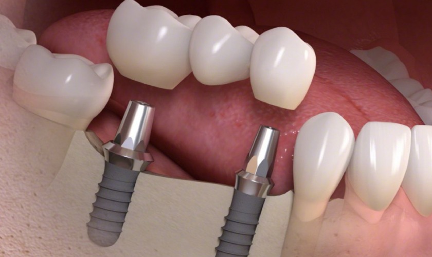 Cầu răng sứ Implant