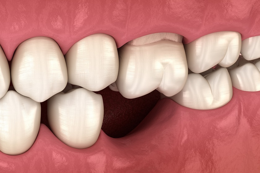 Trồng răng implant sớm để tránh bị tiêu xương