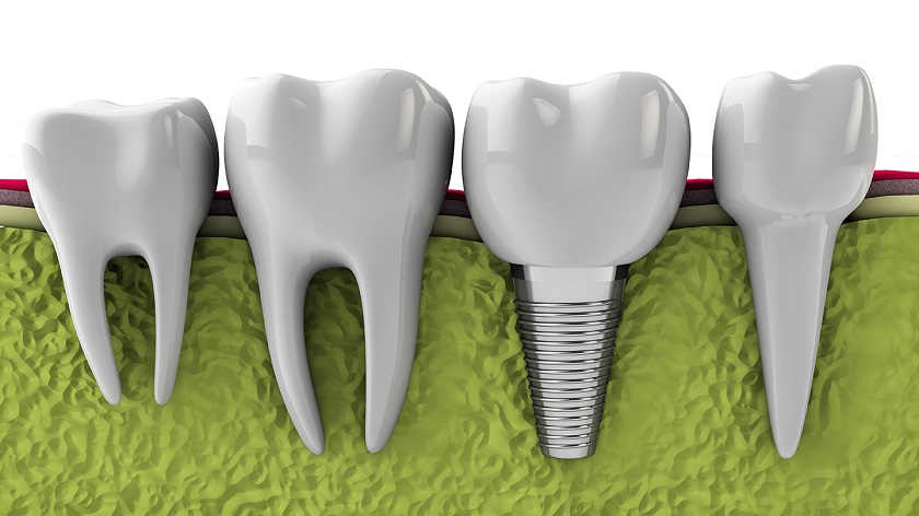 Quy trình khi trồng răng implant