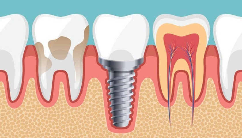 Giá trồng răng Implant trọn gói là bao nhiêu? Giá trồng răng Implant trọn gói là bao nhiêu?