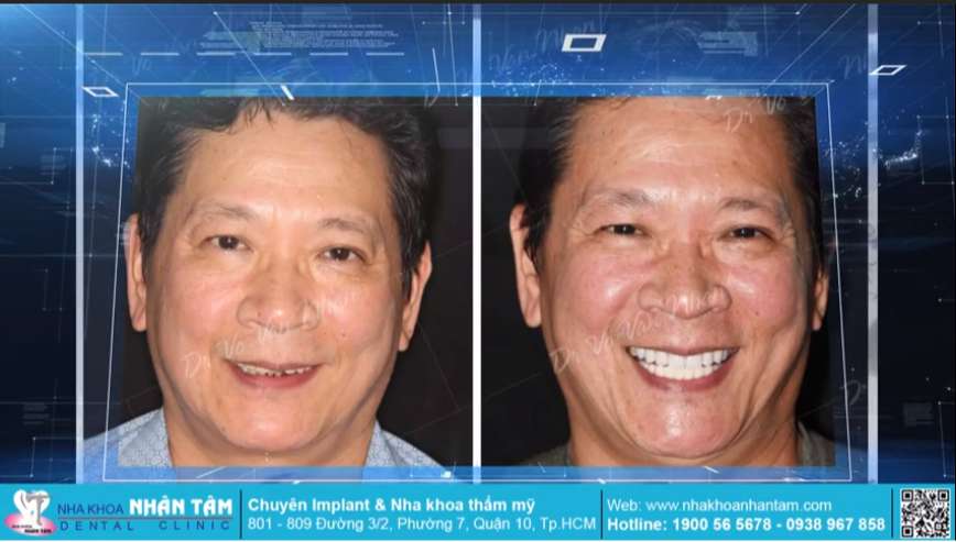 Chú Bảnh trước và sau khi trồng răng Implant tại nha khoa Nhân Tâm