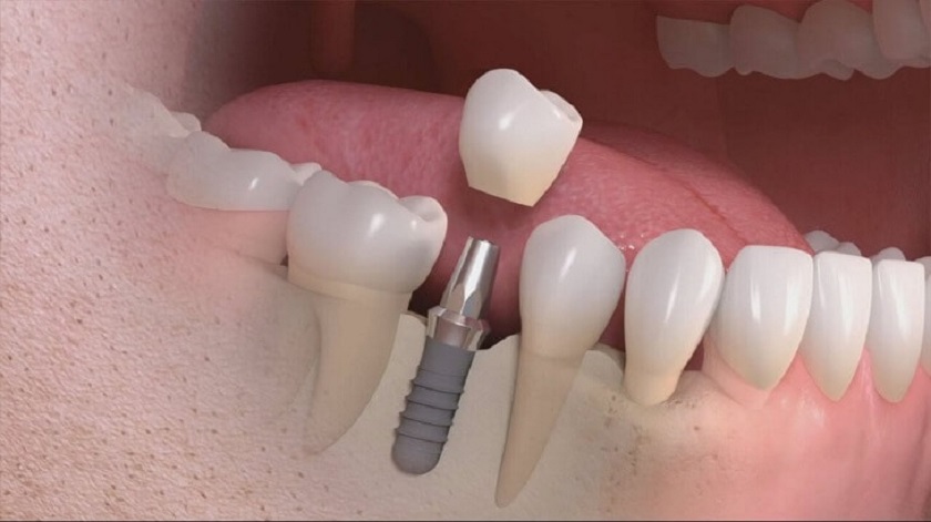 Trồng răng Implant có nguy hiểm tới sức khỏe không