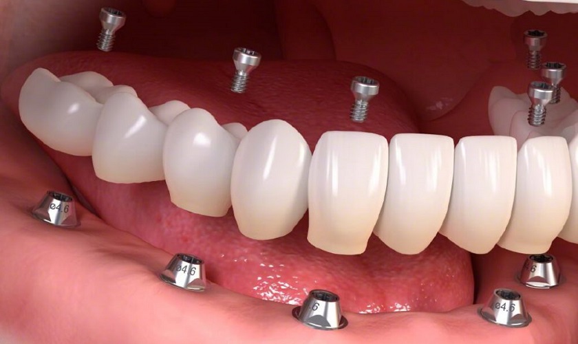 Có nên trồng răng bằng phương pháp Implant không?