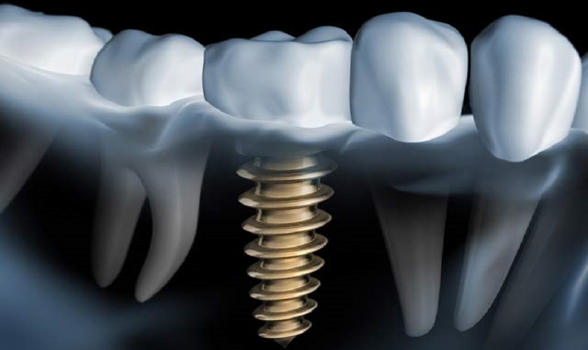 Công nghệ làm răng Implant tân tiến nhất hiện nay