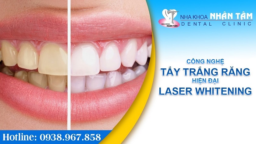 Giới thiệu về công nghệ tẩy trắng răng hiện đại Laser Whitening