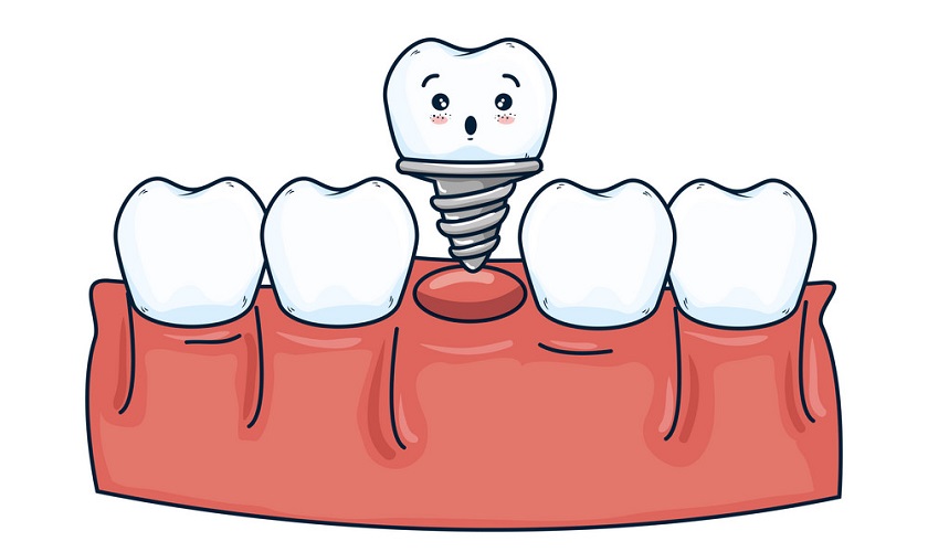 Nha khoa Nhân Tâm dịch vụ trồng răng Implant chất lượng cao