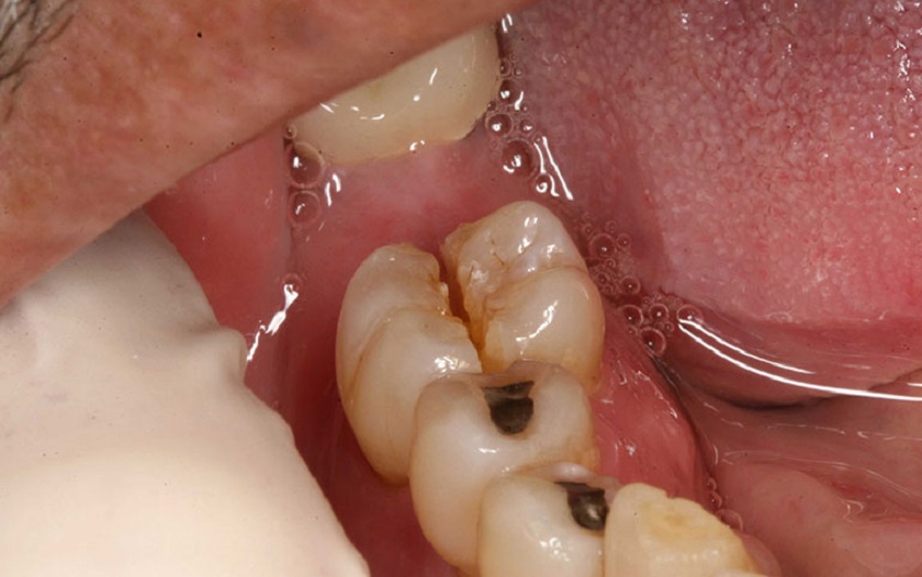 Trường hợp khoảng trống mất răng quá hẹp thì không nên đặt trụ Implant