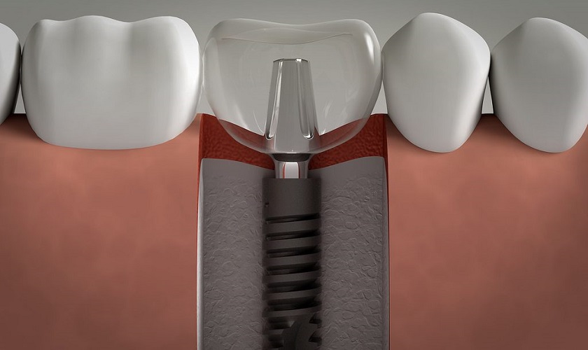 Đối tượng nào không nên trồng răng Implant?