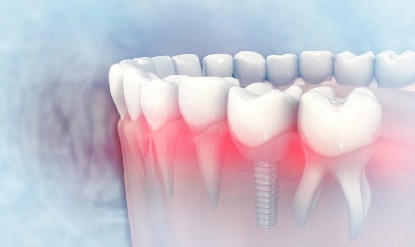 Giá cả làm răng Implant tại cơ sở nha khoa uy tín