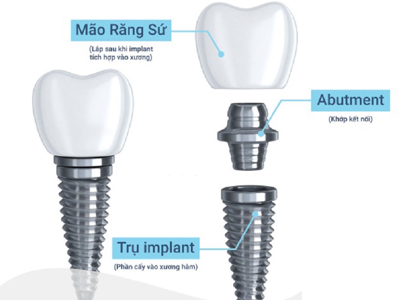 Cấu tạo hoàn chỉnh của một chiếc răng Implant