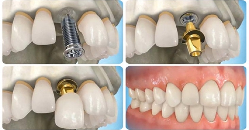 Quy trình trồng răng sẽ được bắt đầu sau khi bác sĩ đã thăm khám và đánh giá kỹ lưỡng tình trạng khách hàng