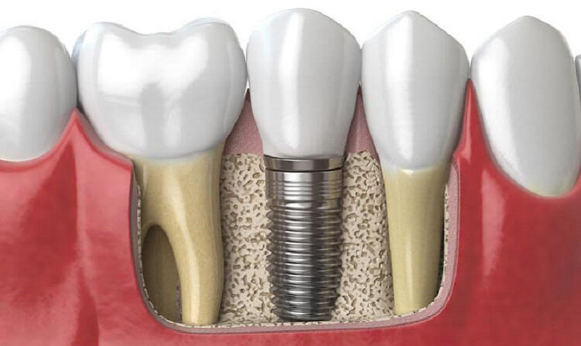 Giải đáp các câu hỏi thường gặp về làm răng Implant