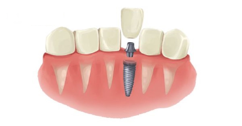 Cấy Implant tức thì sau khi nhổ răng giúp rút ngắn thời gian trị liệu