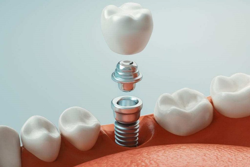 Có thể cấy Implant sau nhổ răng từ 4 đến 6 tháng