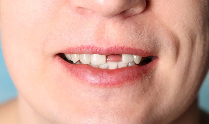 Trồng răng Implant đem lại hiệu quả khôi phục thẩm mỹ và chức năng ăn nhai vượt trội