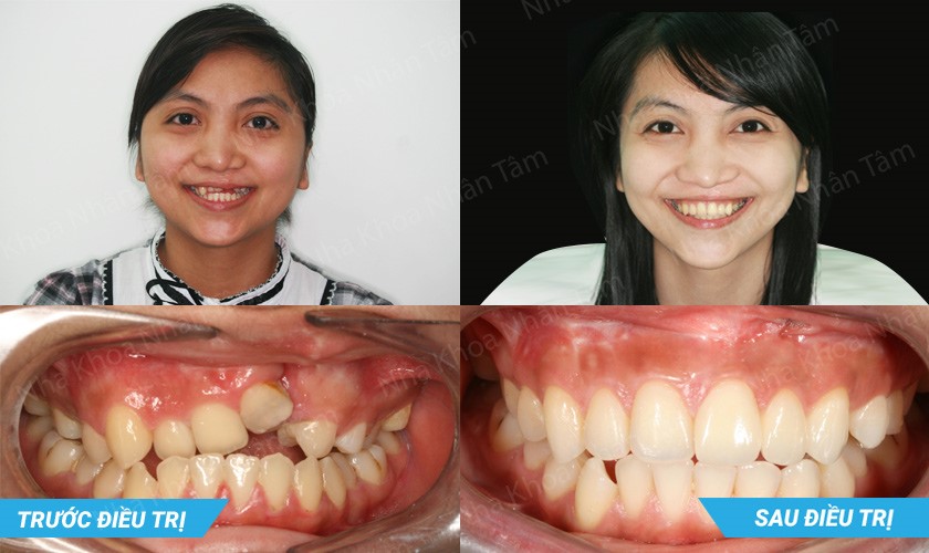 Hình ảnh trồng răng Implant kết hợp chỉnh nha, ghép xương để phục hình cho khách hàng có khe hở môi và hở một bên cung răng