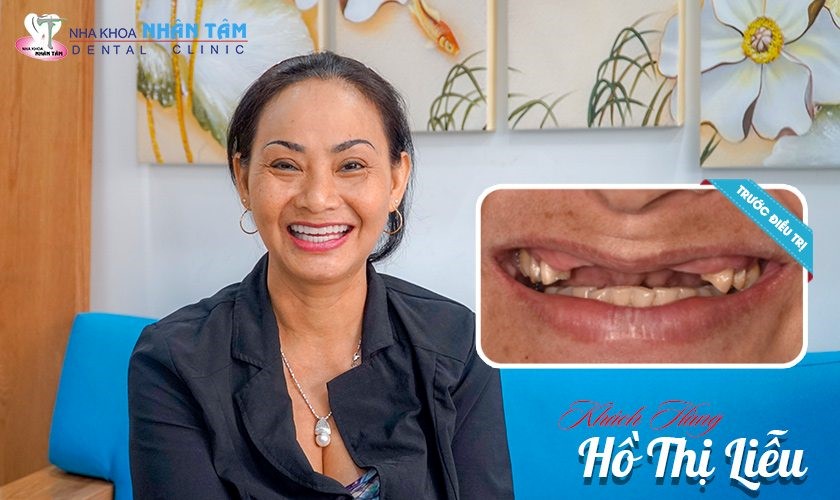Hình ảnh trồng răng Implant khôi phục nhiều răng mất liền kề khách hàng Hồ Thị Liễu