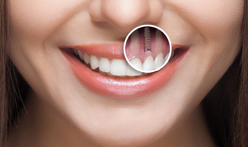Hình ảnh trồng răng Implant thực tế tại Nha khoa Nhân Tâm