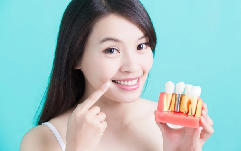 Bạn có thể sử dụng răng Implant trọn đời sau khi cấy ghép