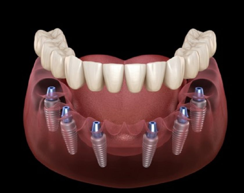 Răng Implant sẽ ổn định và giữ lâu hơn