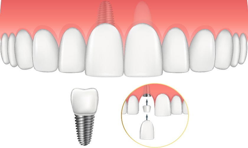 Trồng Implant răng cửa như thế nào? Giá bao nhiêu?