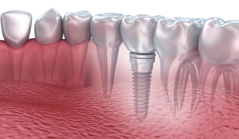 Trụ Implant Tekka Kontact cho phép phục hình răng không cần ghép xương đối với trường hợp xương xốp