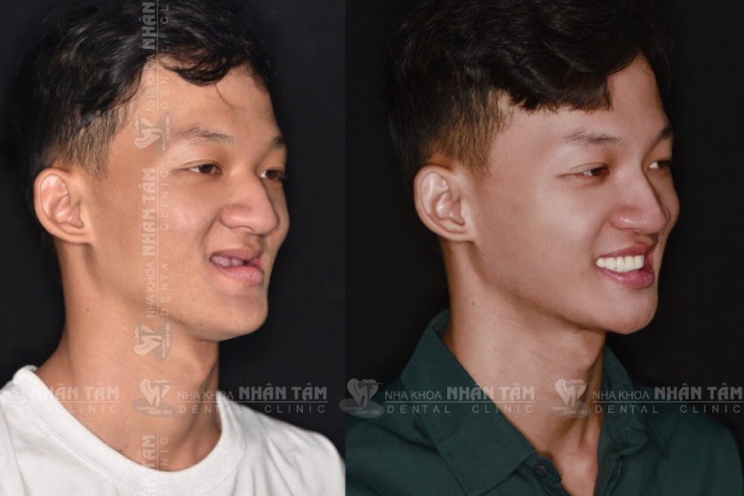  Khách hàng N.K.T trước và sau khi điều trị tại Trung Tâm Implant Việt Nam