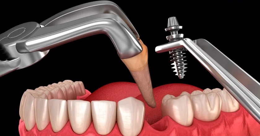 Có thể cấy ghép Implant tức thì sau khi nhổ răng