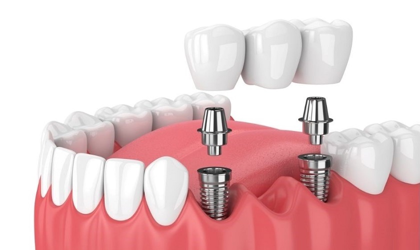 Phục hình răng Implant với trường hợp mất nhiều răng cạnh nhau