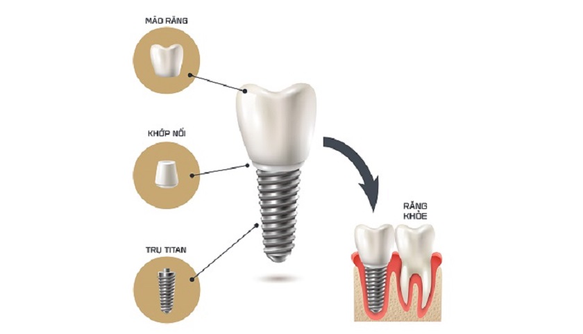 Cấu tạo hoàn chỉnh của 1 răng Implant