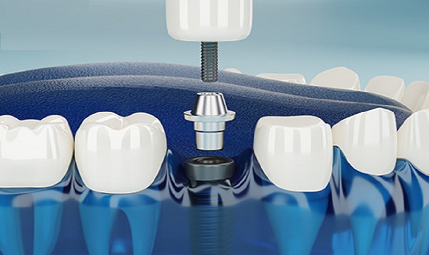 Khi nào thì trồng răng Implant?