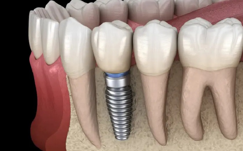 Phục hình răng mất bằng cấy ghép Implant