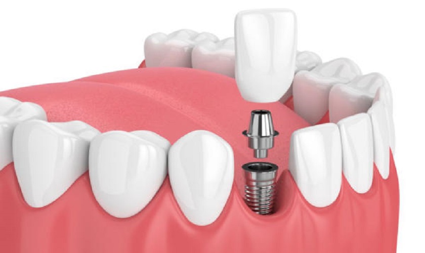 Trồng răng Implant giúp bảo tồn tối đa các răng thật còn lại trên cung hàm