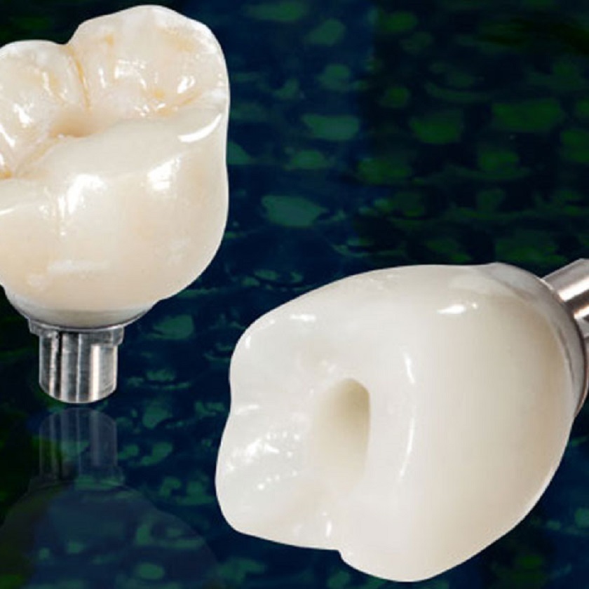 Răng sứ trên Implant có màu sắc và hình dáng tương tự răng thật