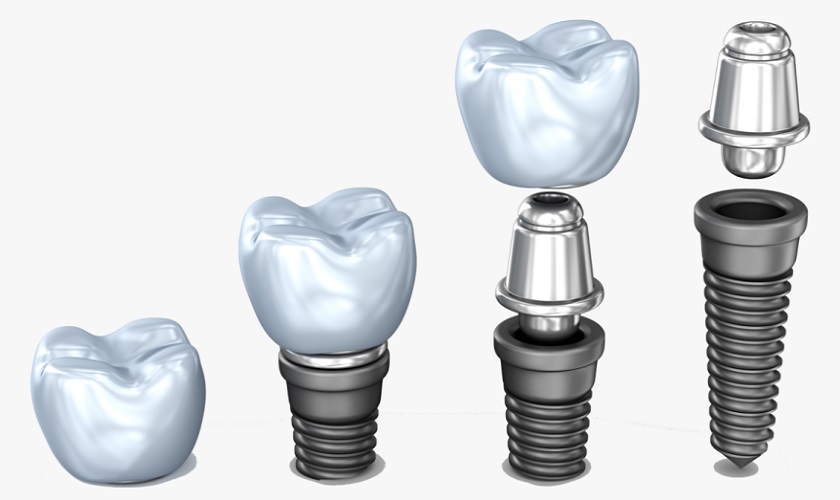 Lựa chọn loại trụ Implant và thân răng phù hợp để đảm bảo hiệu quả phục hình