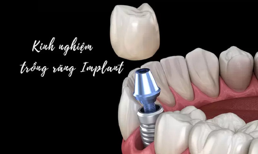 Kinh nghiệm trồng răng Implant an toàn và nhanh hồi phục