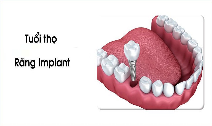Làm răng Implant bền được bao lâu?