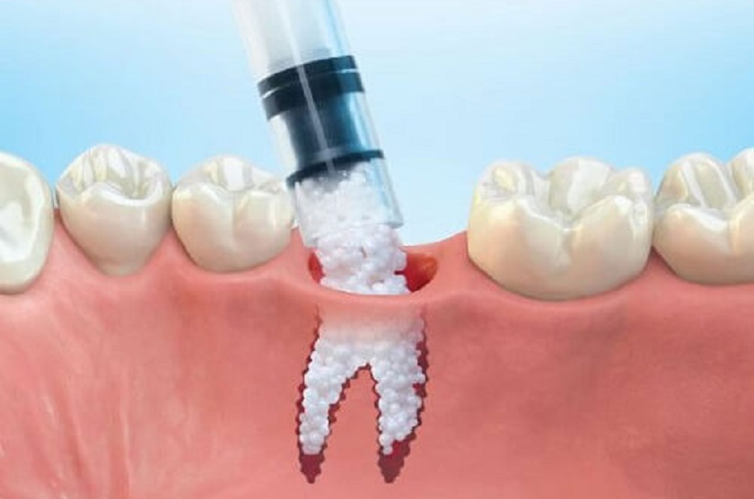 Việc ghép xương sẽ làm tổng chi phí trồng răng Implant tăng lên