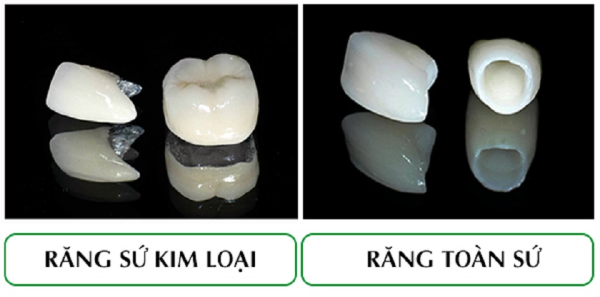 Răng sứ kim loại có mức giá tiết kiệm hơn so với răng toàn sứ