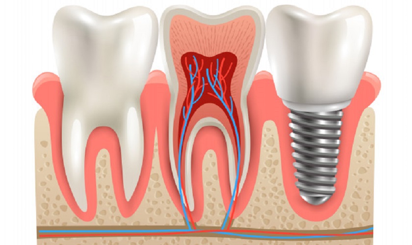 Làm sao giảm chi phí trồng răng Implant nhưng hiệu quả cao?
