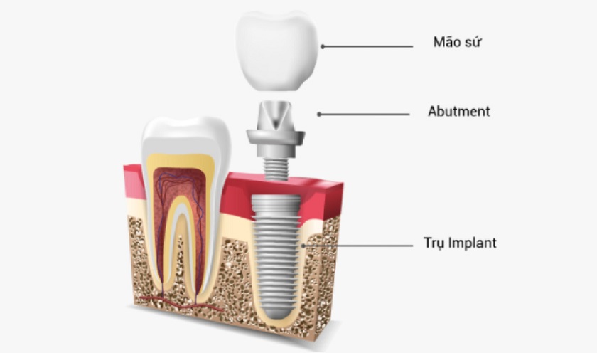 Cấu tạo của răng Implant dựa trên cấu trúc của răng tự nhiên