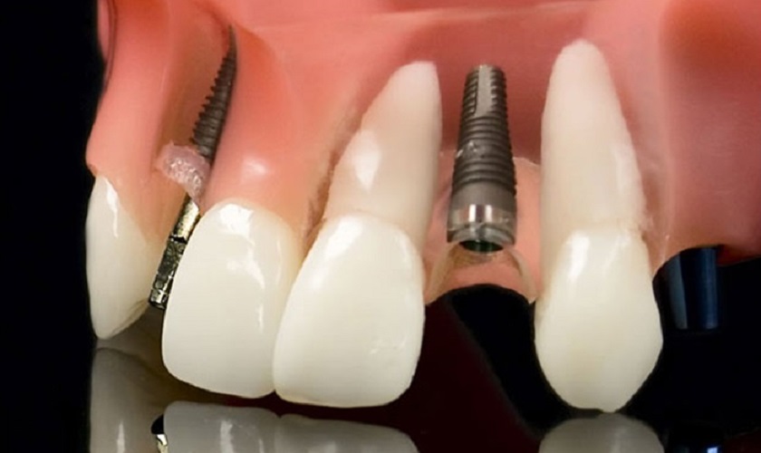 Lưu ý sau khi trồng răng Implant mà bạn nên biết