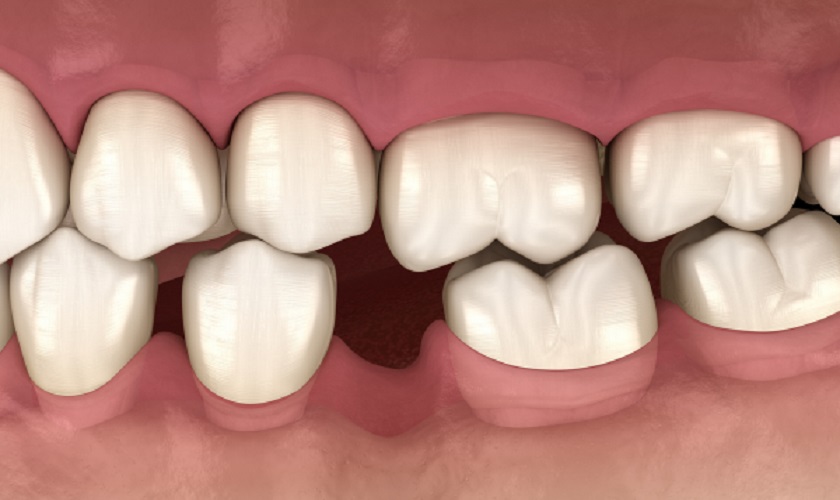 Mất răng lâu năm dẫn đến tiêu xương, biến dạng khuôn mặt