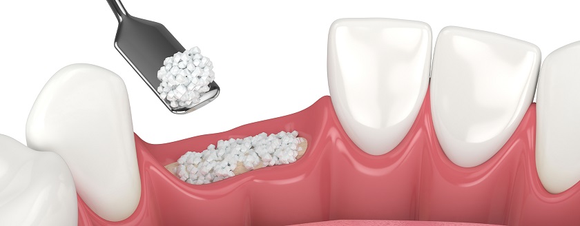 Khách hàng mất răng lâu năm khiến xương hàm tiêu biến cần ghép xương trước khi trồng răng